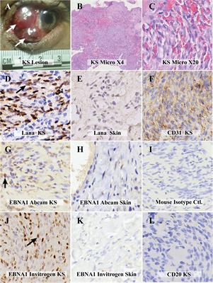 Co-infection and co-localization of Kaposi sarcoma-associated herpesvirus and Epstein-Barr virus in HIV-associated Kaposi sarcoma: a case report